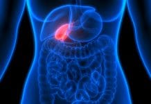 Saiba tudo sobre a cirurgia de pedra na vesícula