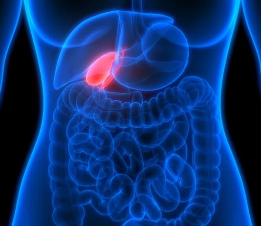 Saiba tudo sobre a cirurgia de pedra na vesícula