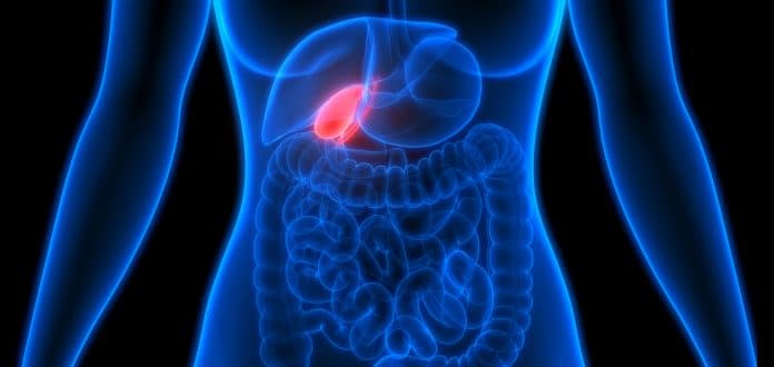 Saiba tudo sobre a cirurgia de pedra na vesícula